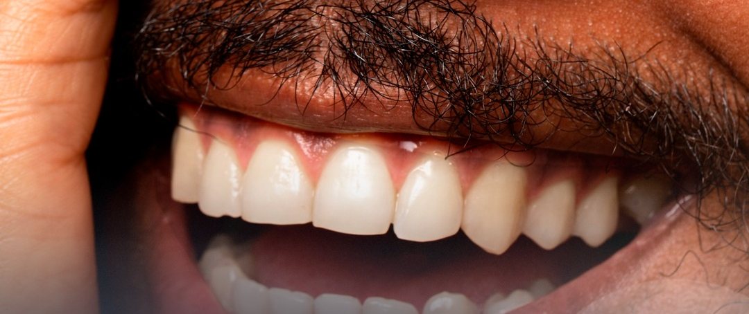 Sorriso transformado com facetas de porcelana