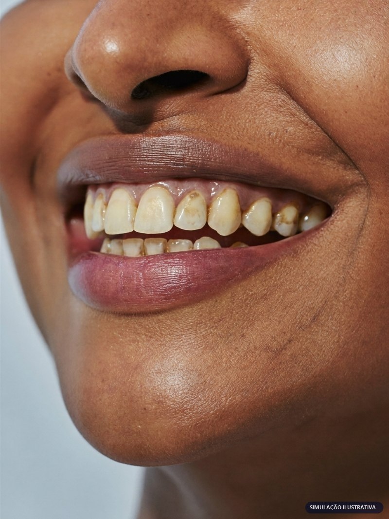 Simulação ilustrativa: dentes amarelados antes do clareamento