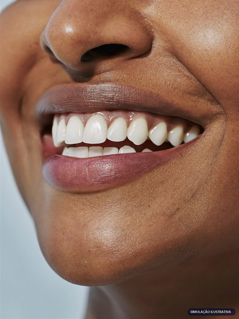 Simulação digital ilustrativa do resultado de clareamento dental